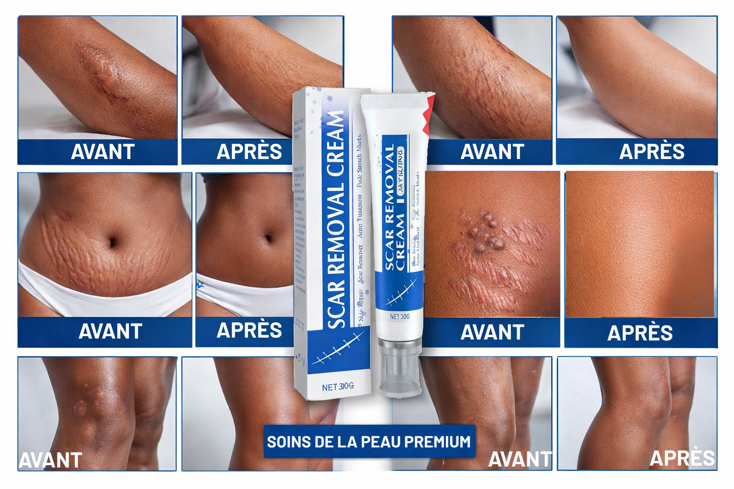 Crème Anti-Cicatrices et Vergeture
